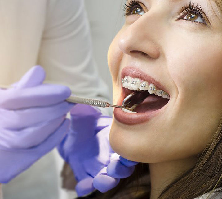 Ceramic braces — Medissa Clinic