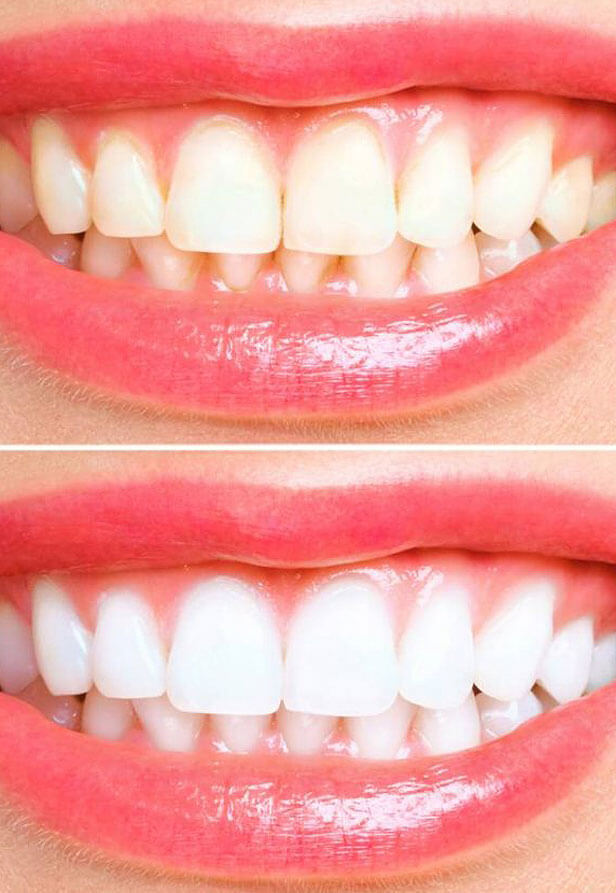 img-teeth-whitening