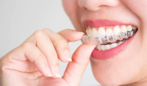 Invisalign Treatment