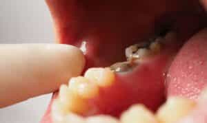 Root Canal Treatment