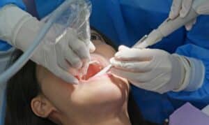 Root Canal Treatment Melissa