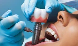 Dental Implants Feel in Your Mouth