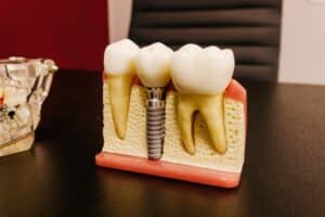 Bone Loss Around Dental Implants