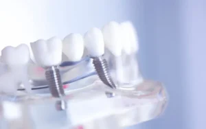 Can You Replace All Your Teeth with Dental Implants?