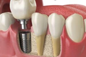 Can You Replace All Your Teeth with Dental Implants