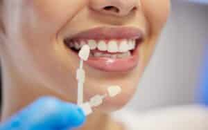 Are Dental Veneers Permanent