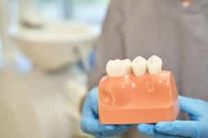 Can Dental Crowns Be Whitened