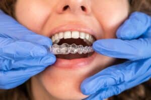 Can Clear Aligners Fix an Overbite