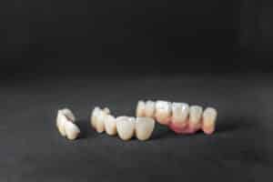 Can a Dental Crown Be Replaced