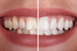 Can Teeth Whitening Strips Damage Teeth