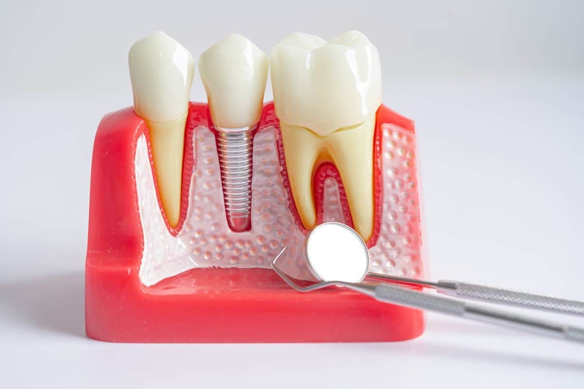 dental implant recovery timeline