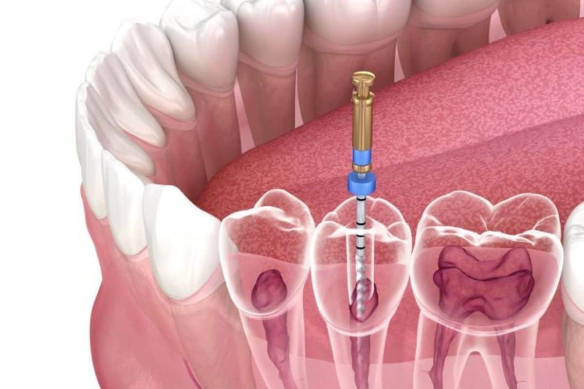 signs you may need root canal treatments